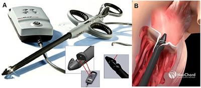 Transcatheter Mitral Valve Chordal Repair: Current Indications and Future Perspectives